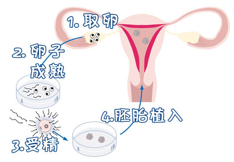 关于供精试管供卵中介